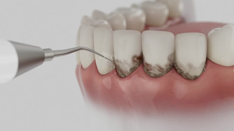 Reliable Wisdom Tooth Removal contractor in Newton County County, GA by Dentist Open Now